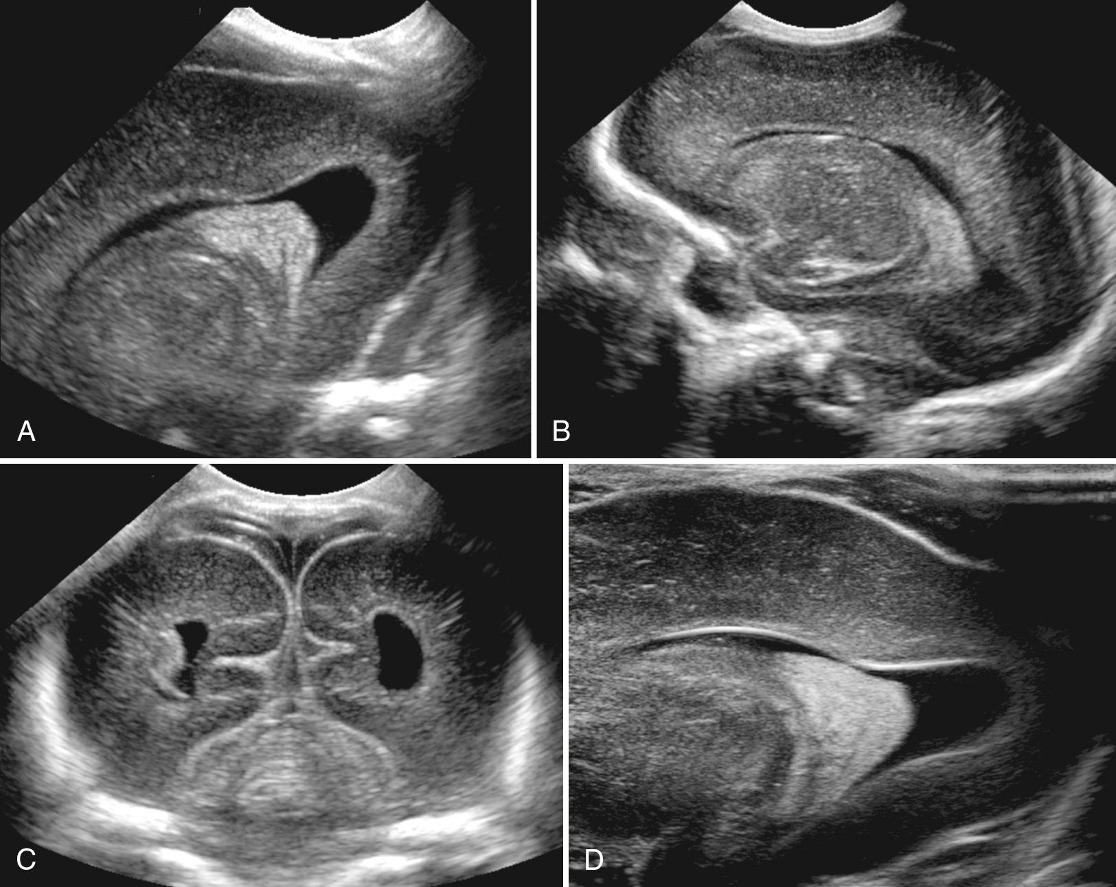 FIG. 45.8, Occipital Horn.