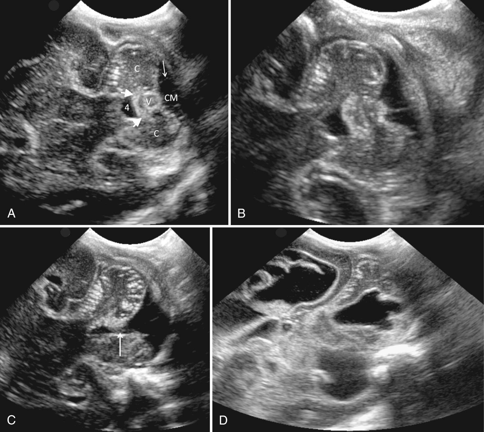 FIG. 45.9, Mastoid Fontanelle Images at Fourth Ventricle Level in Posterior Fossa.