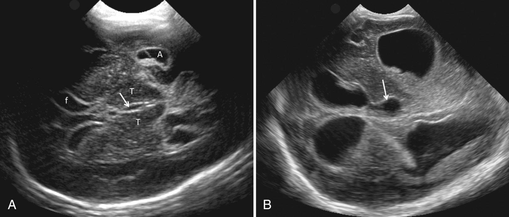 FIG. 45.10, Mastoid Fontanelle Images of the Midbrain Level Above Fourth Ventricle in Neonates With Posthemorrhagic Hydrocephalus.