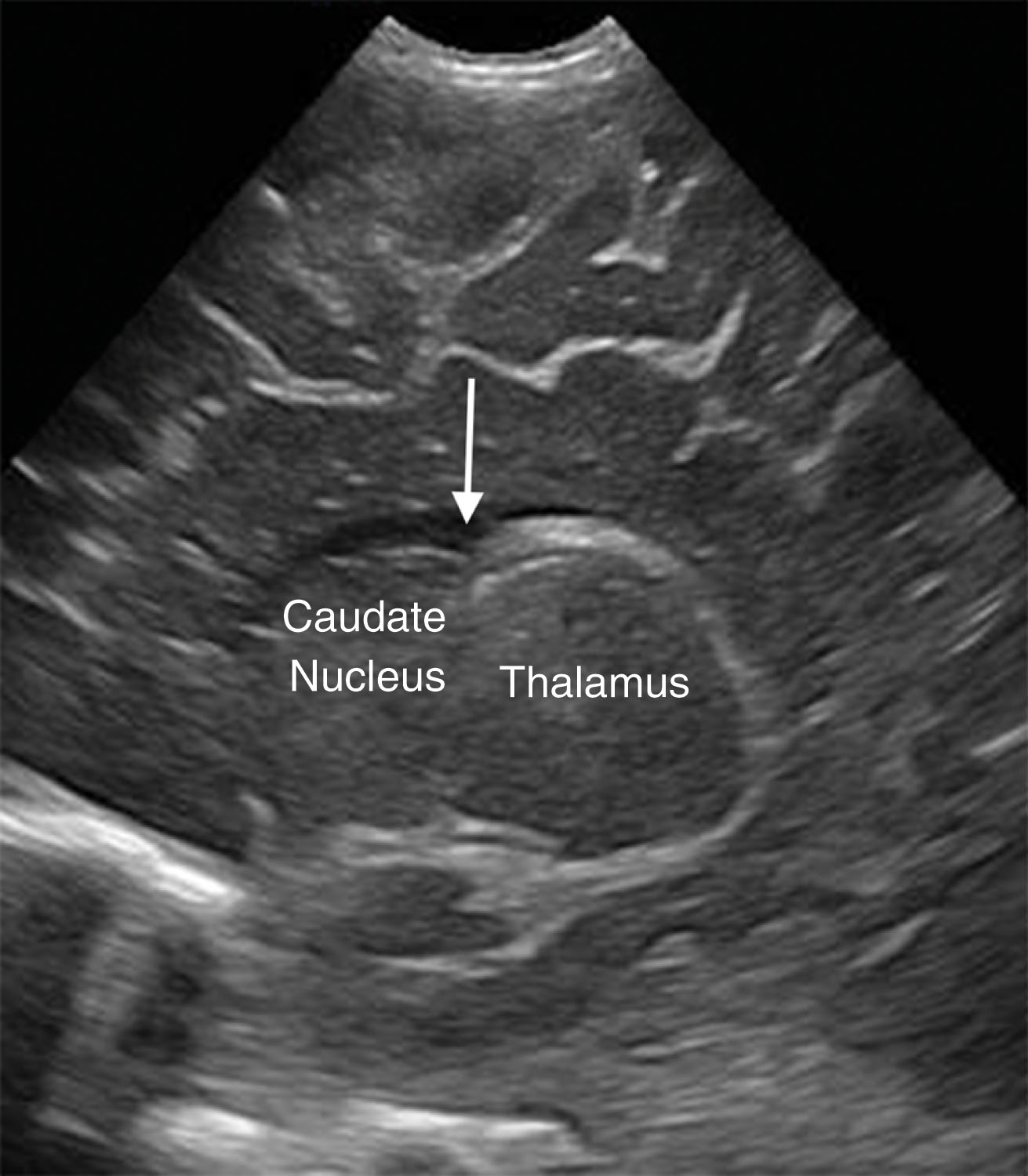 Fig. 27.11, Caudothalamic groove