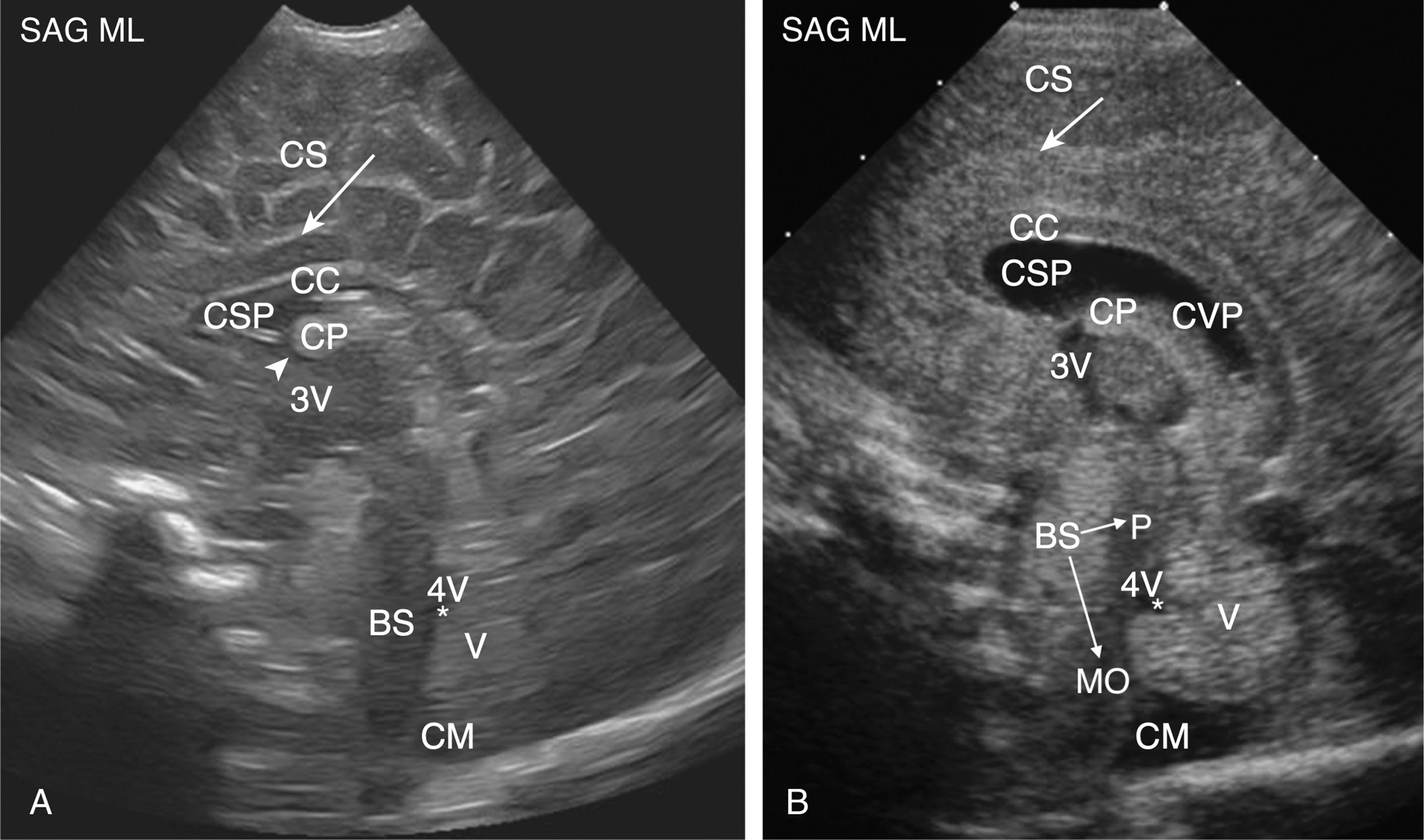 Fig. 27.13, Normal midsagittal brain anatomy in a term infant and extremely premature infant