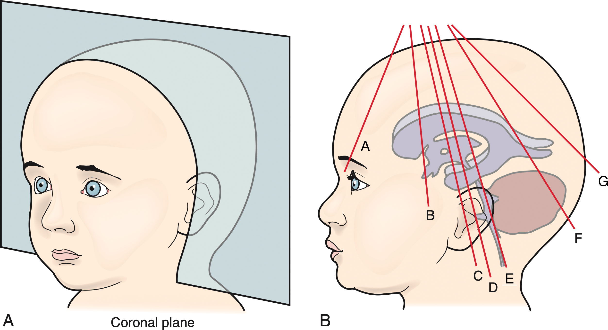 Fig. 27.14, Coronal scanning planes