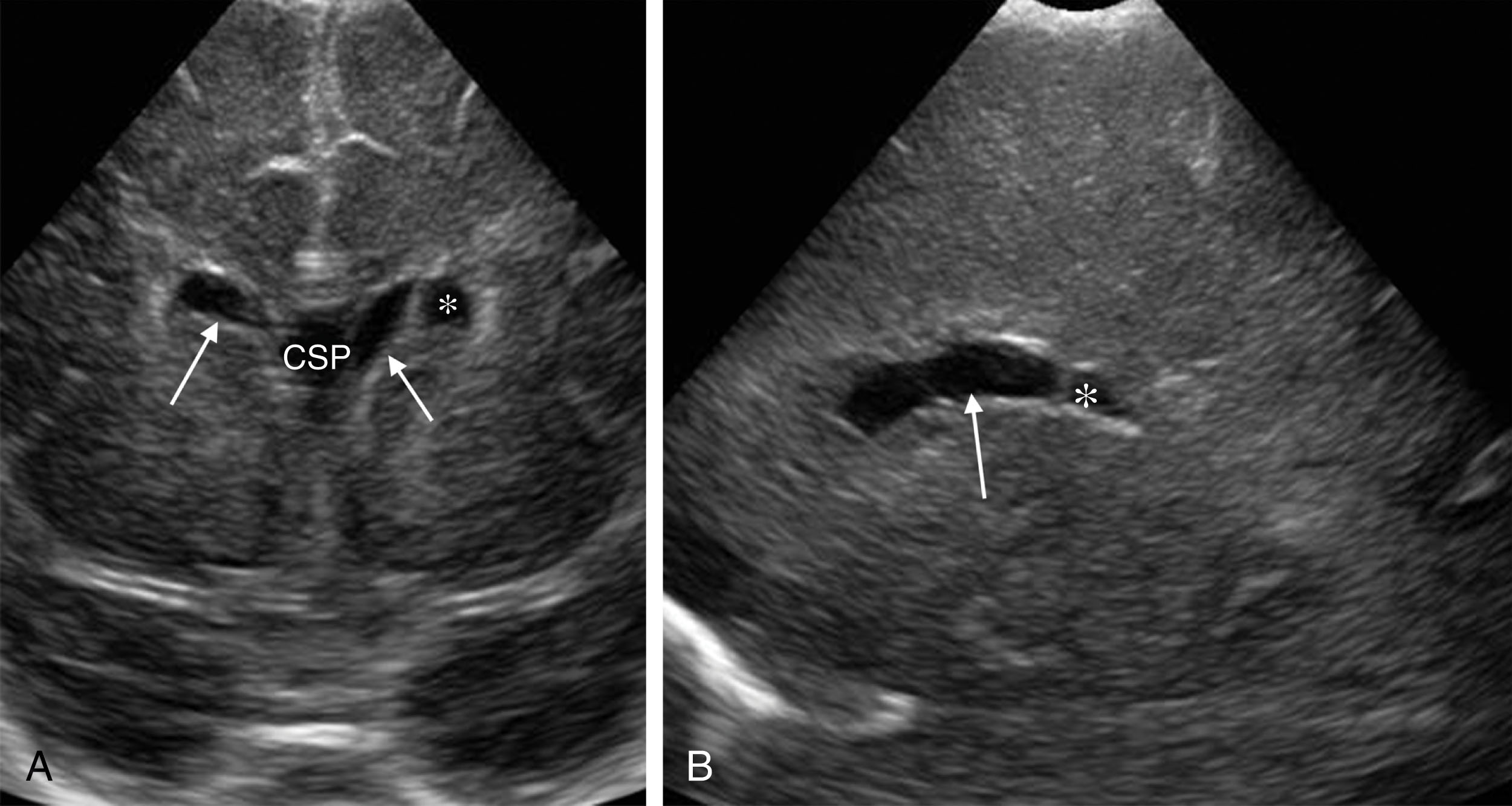 Fig. 27.4, Coarctation of the lateral ventricles