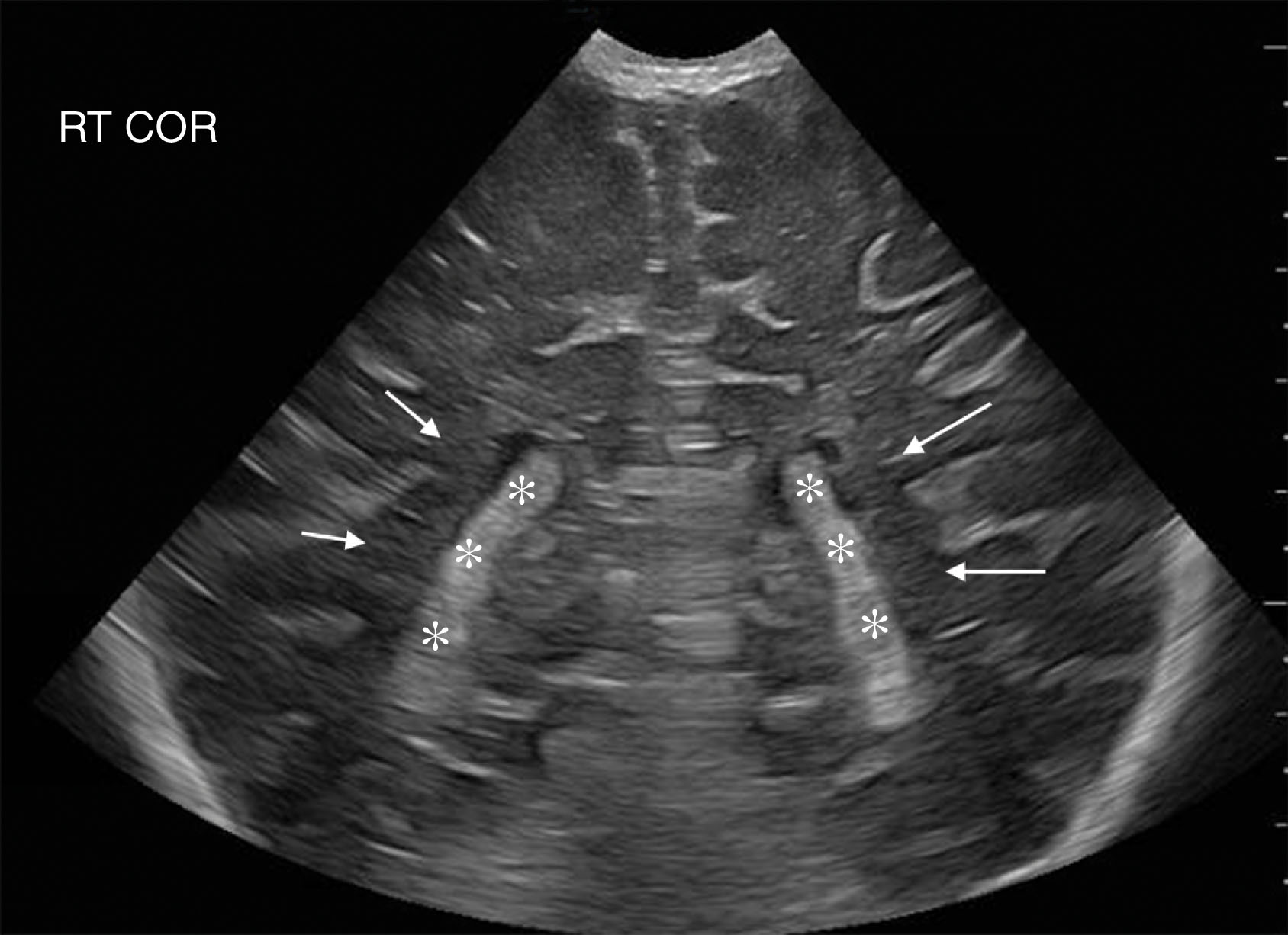 Fig. 27.6, Normal glomus of the choroid plexus