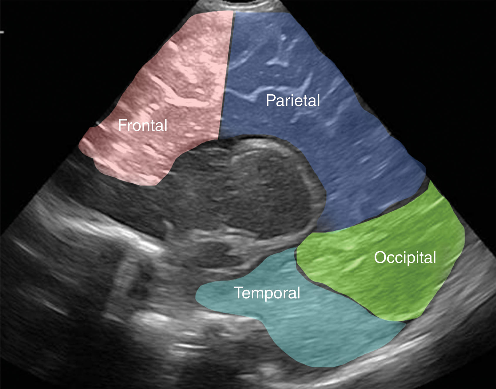 Fig. 27.7, Normal parasagittal view of the cerebrum