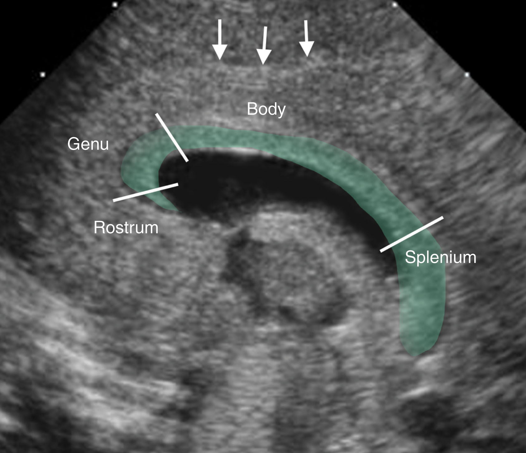 Fig. 27.9, Corpus callosum