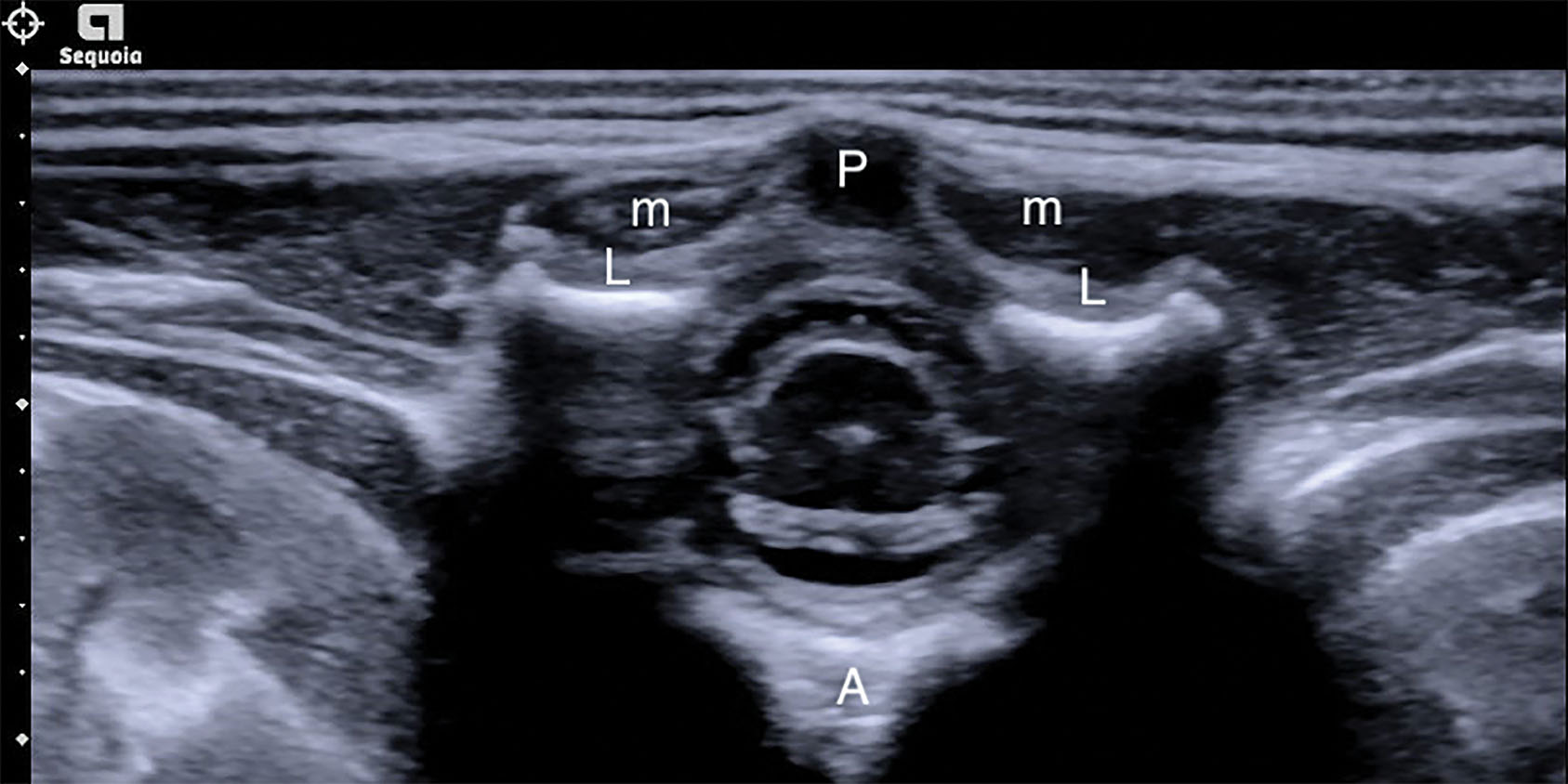 Fig. 29.7, Transverse view of the normal thoracic spine.