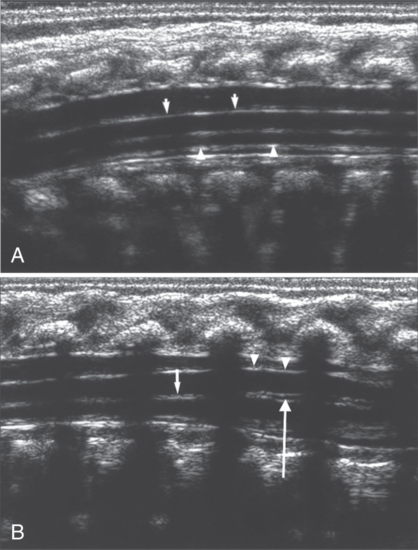 Fig. 29.8, Sagittal view of the normal thoracic spinal cord and ventriculus terminalis variant.