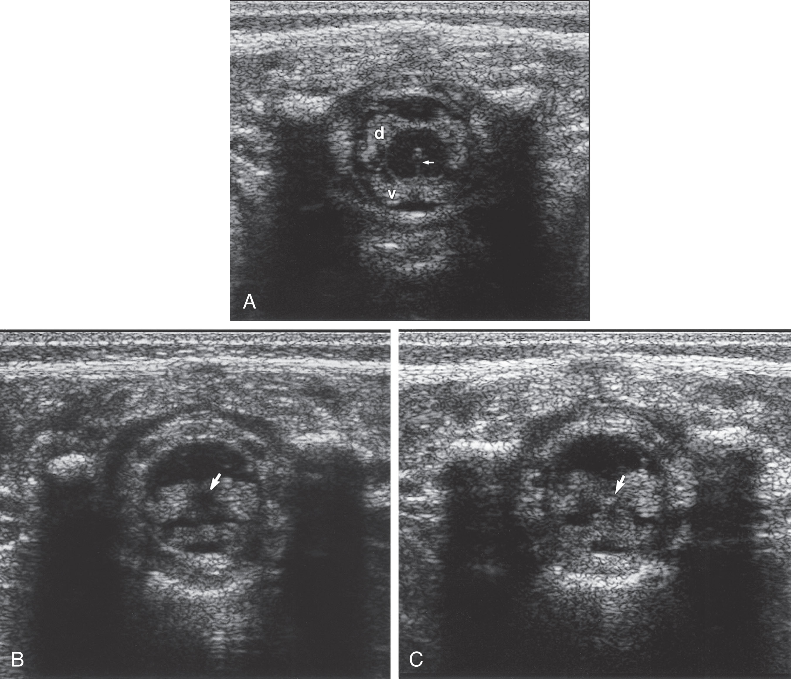 Fig. 29.9, Normal lumbar spinal cord and nerve roots.