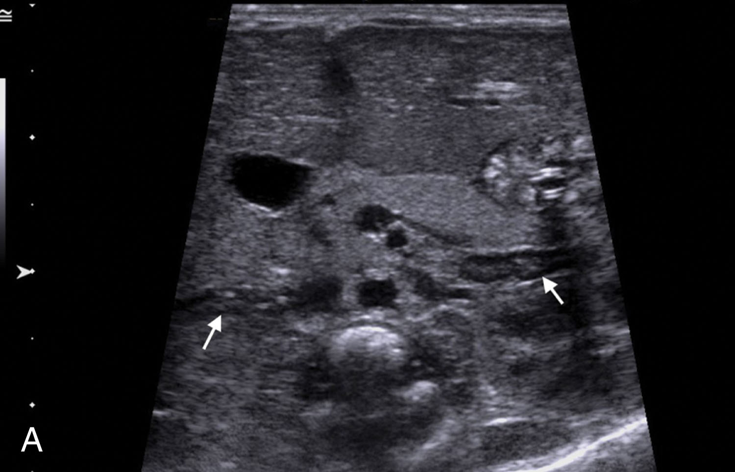 Fig. 25.1, Normal neonatal and pediatric pancreas.