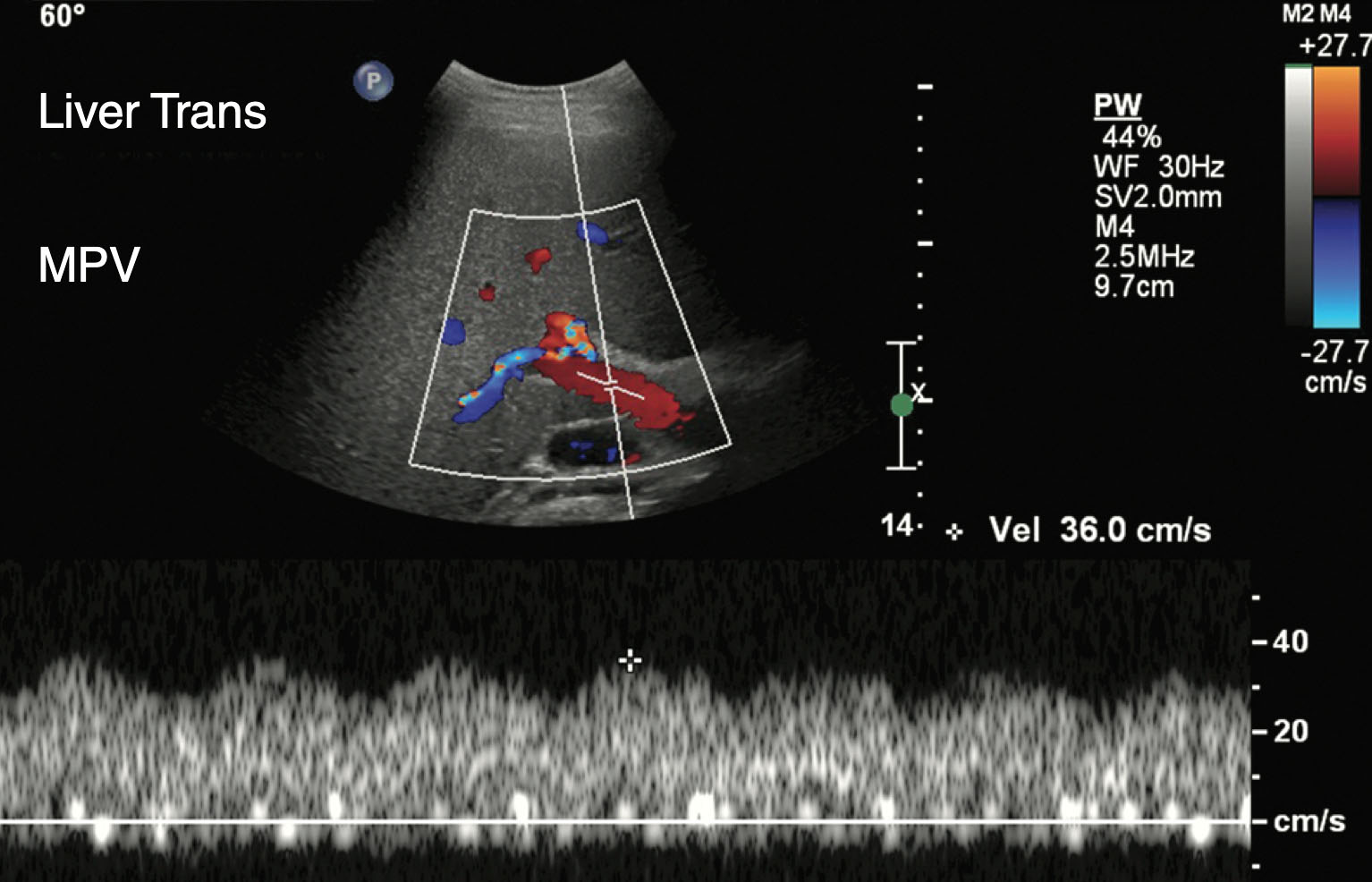 Fig. 25.3, Normal pediatric main portal vein.