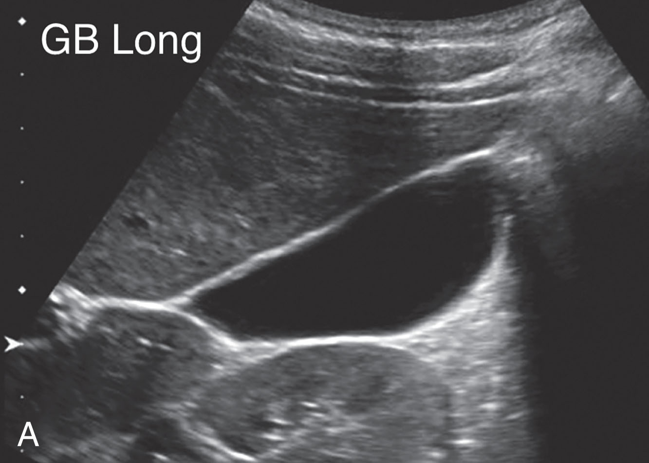 Fig. 25.4, Normal pediatric gallbladder and common bile duct.