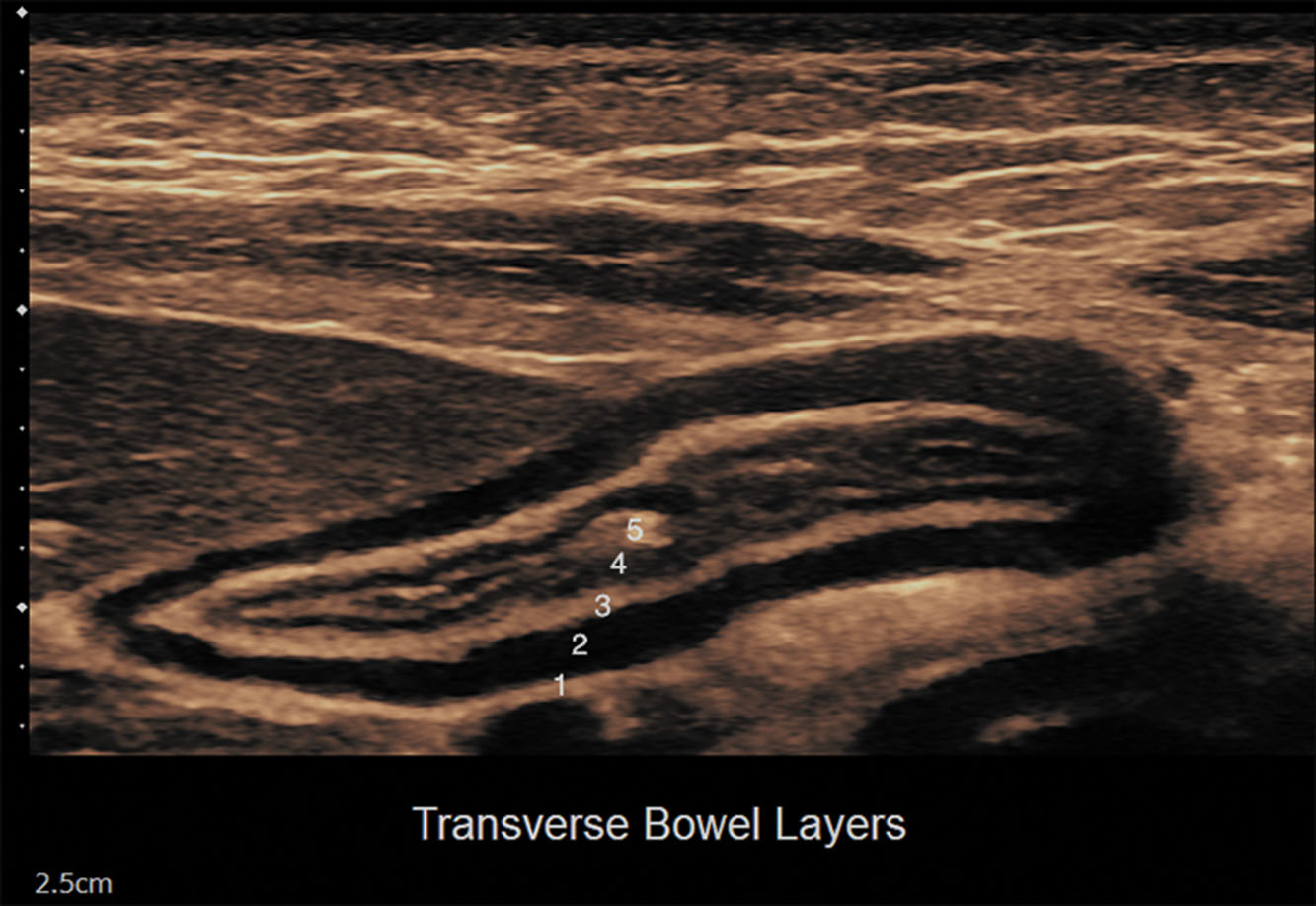 Fig. 25.6, Normal bowel wall layers.