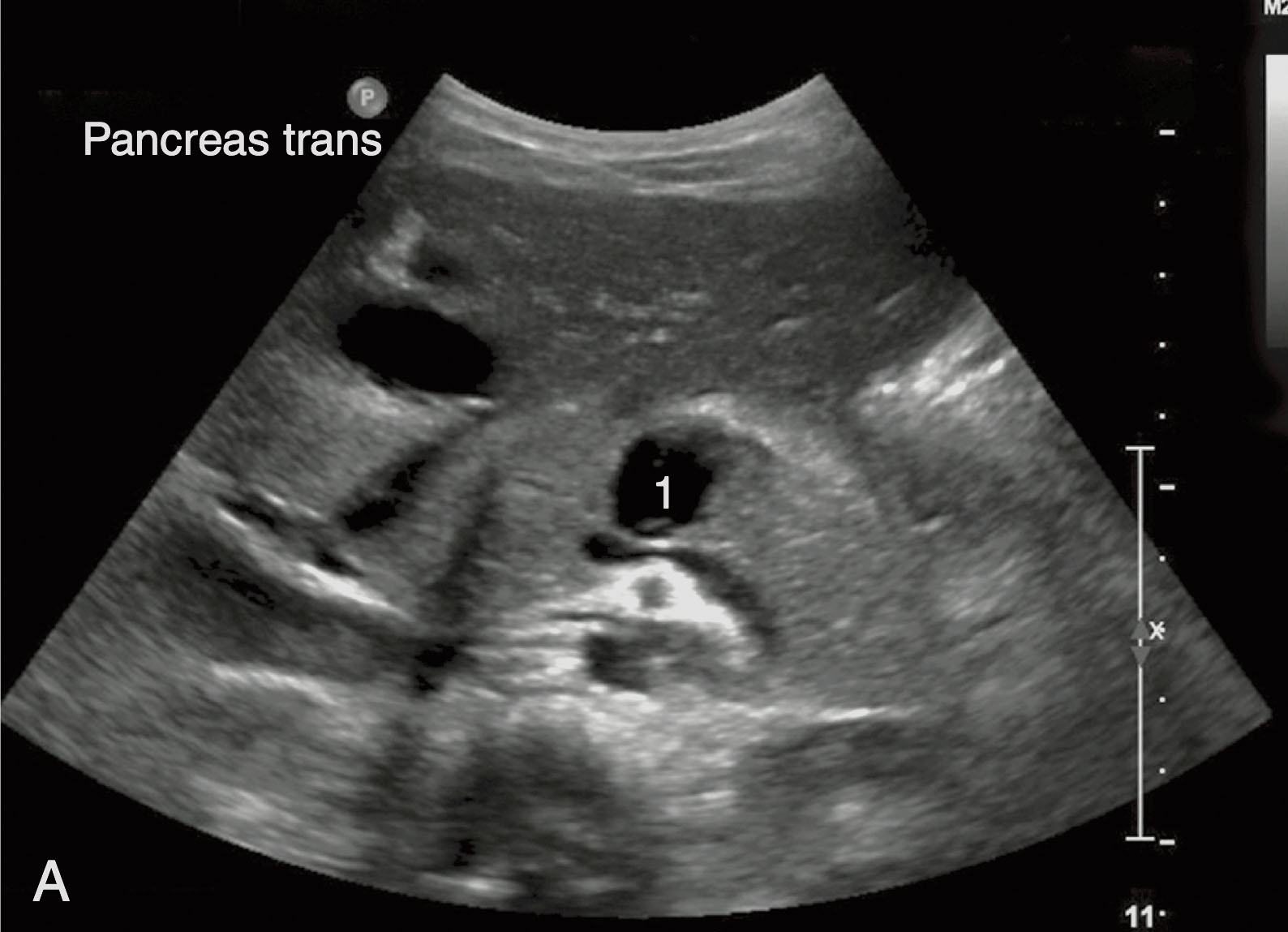 Fig. 25.7, Transected pancreas from trauma.