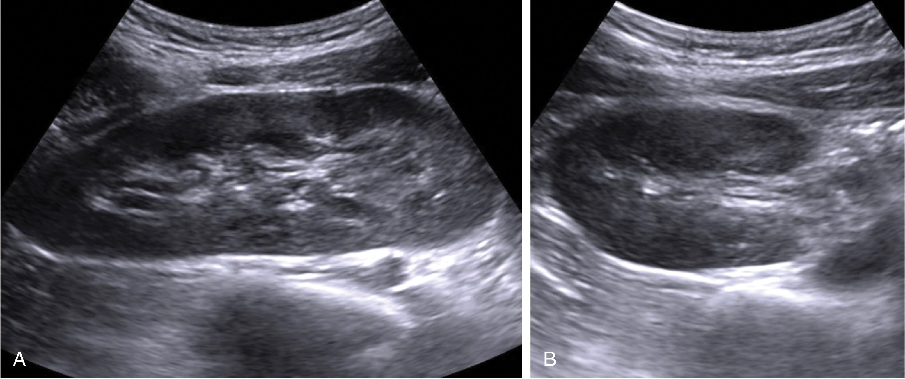 Fig. 26.2, Normal kidney in an adolescent.