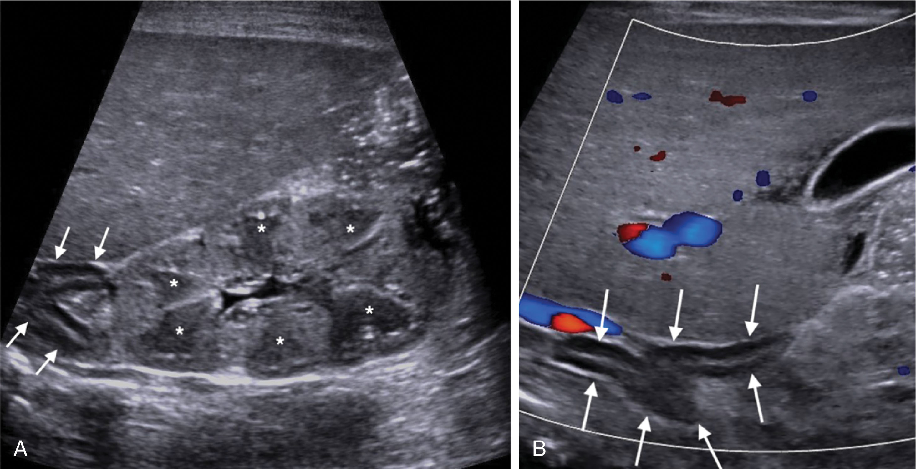 Fig. 26.4, Normal sagittal neonatal adrenal gland and kidney.