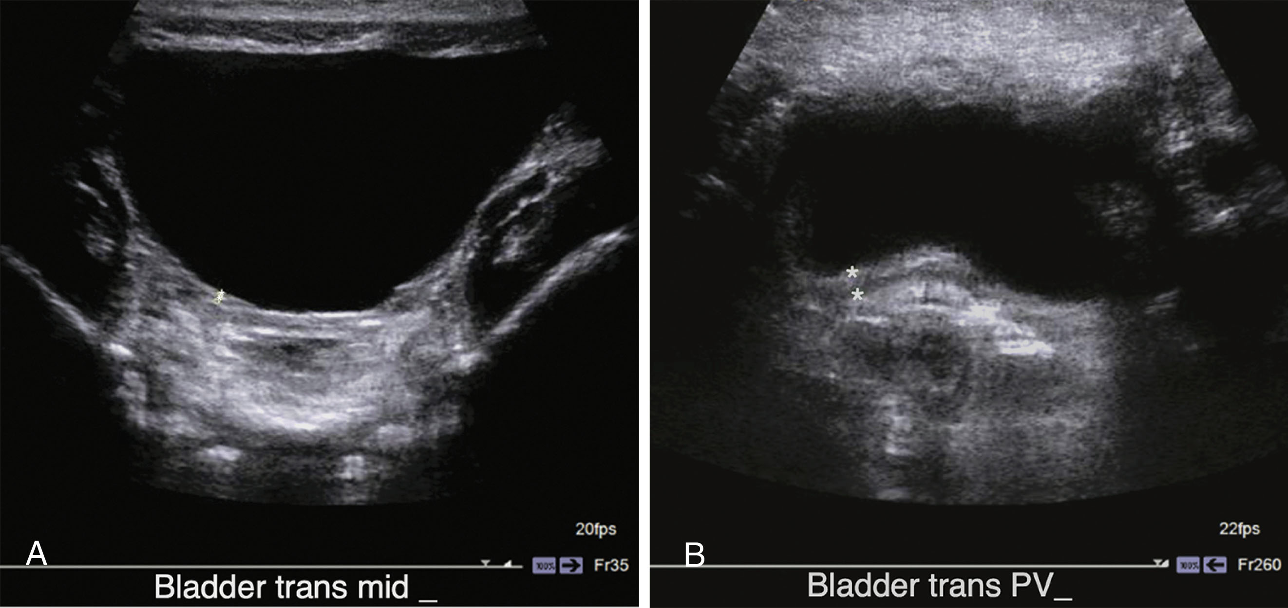 Fig. 26.6, Normal bladder.