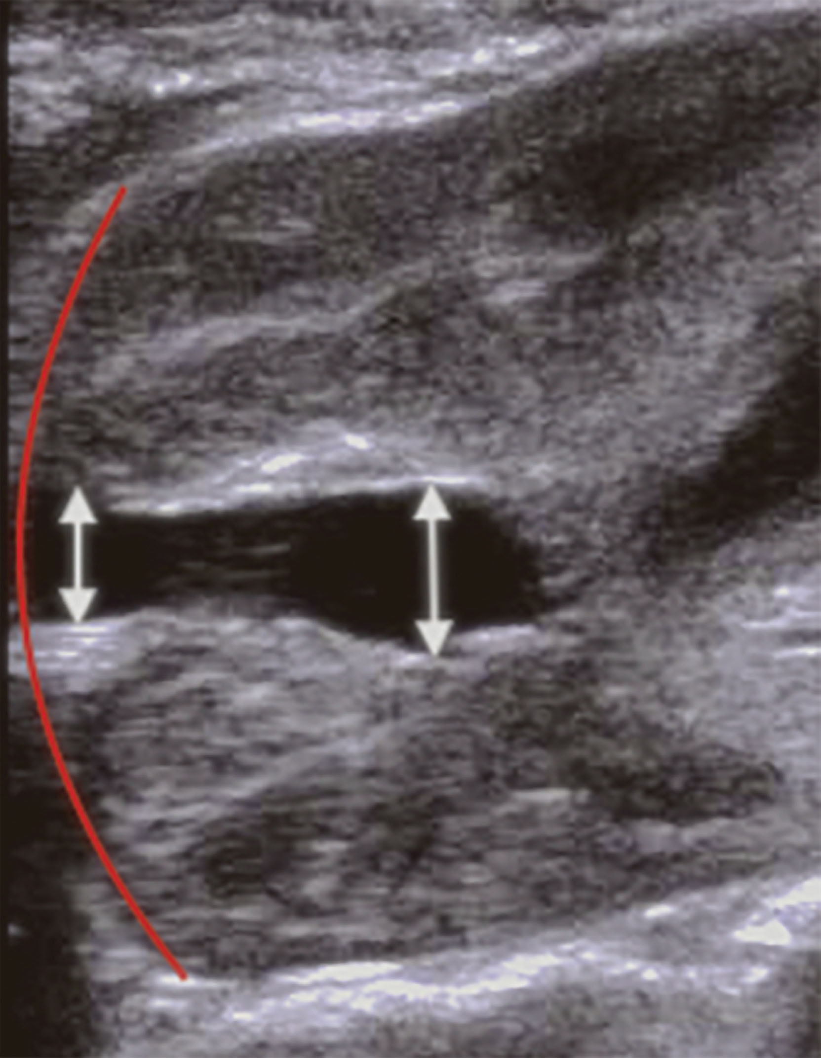 Fig. 26.9, Anterior-posterior renal pelvic diameter.