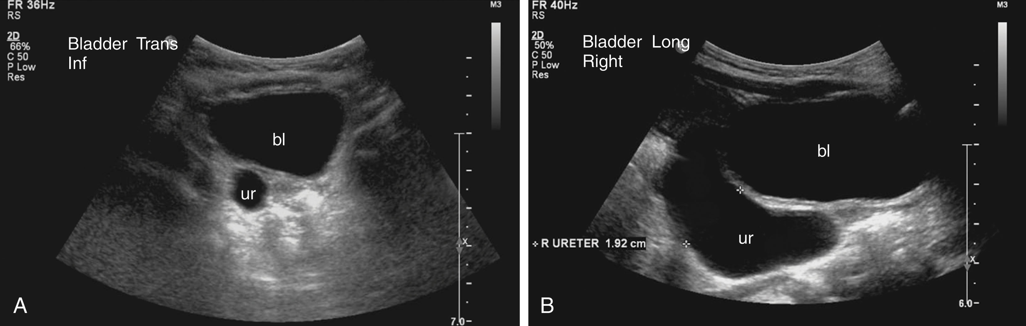 Fig. 26.10, Dilation of the ureter (megaureter).