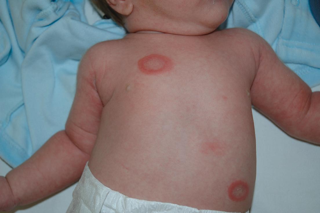 Fig. 4.3.2, Neonatal lupus erythematous annular lesions.