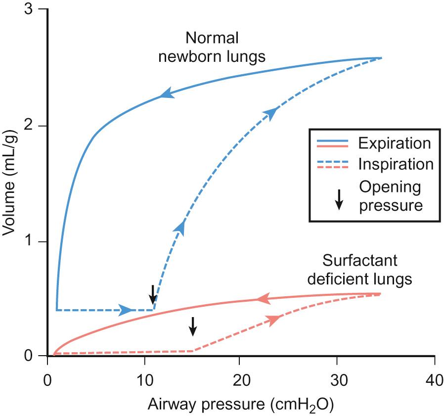 Fig. 11.1, The difference in lung volume for a given airway pressure. If surfactant is present, there is a lower opening pressure, a larger change in volume for a given change in pressure and the lungs do not collapse on expiration.