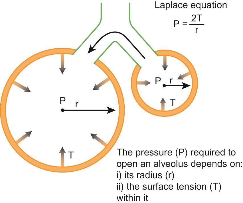 Fig. 11.2, Heterogeneous alveolar collapse in respiratory distress syndrome. In the absence of surfactant, the pressure at the surface of the alveolus is greater in the smaller than in the larger alveolus, so the small alveoli collapse and the large ones expand.