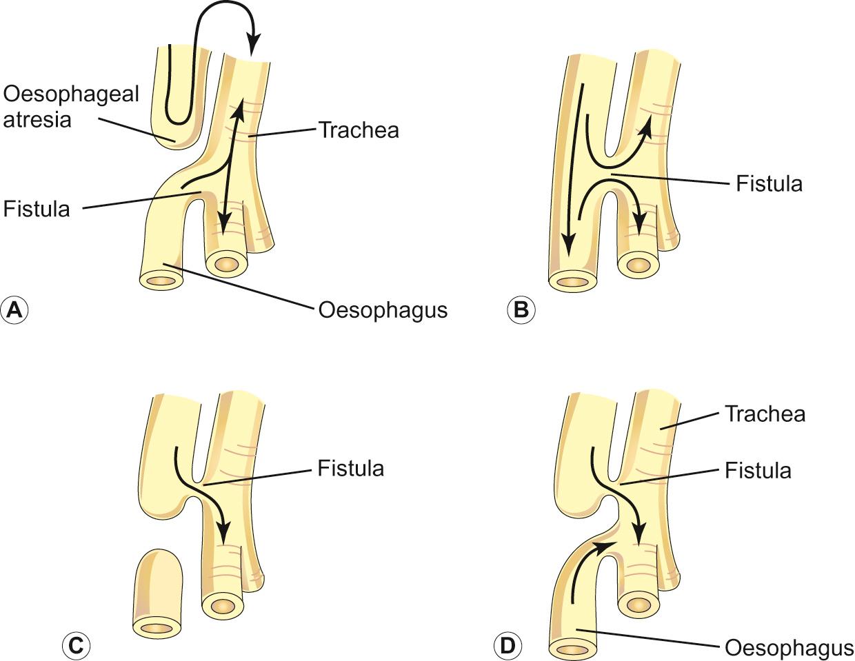 Fig. 11.7, The main varieties of tracheo-oesophageal fistula, shown in order of frequency. Possible directions of the flow of the contents are indicated by arrows. A. Oesophageal atresia associated with distal tracheo-oesophageal fistula (91%). B. H-type fistula between the trachea and the oesophagus, no oesophageal atresia (4%). C. Atresia with proximal oesophageal fistula with distal oesophagus as blind pouch. Air cannot enter the distal oesophagus or stomach (4%). D. Atresia with fistulas between the trachea and both the proximal and the distal segments of the oesophagus (1%).