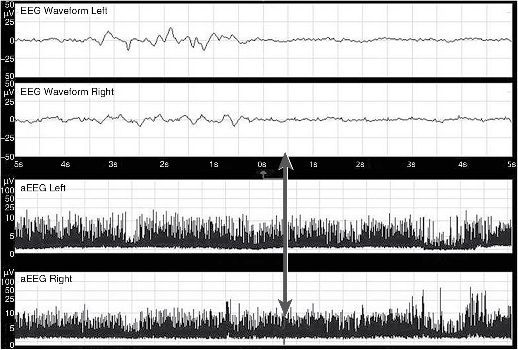 Fig. 19.4, Dual channel amplitude-integrated EEG (aEEG) recorded from a full-term infant. The top two panels display 10 seconds of “raw” EEG, whereas the bottom two panels display 3 hours of aEEG. The arrow indicates the point on the aEEG that corresponds to the raw EEG panels.