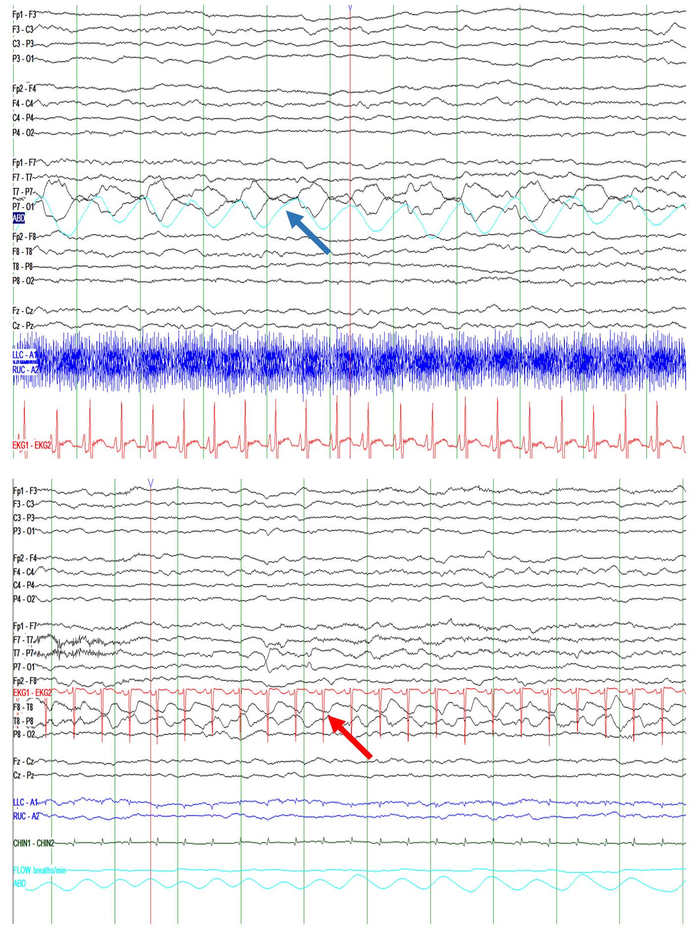 Fig. 19.5, Polygraphic recordings permit correct identification of artifact. The top panel shows apparent focal rhythmic activity in the left parietal region at P7. Overlay of the respiratory belt in gray demonstrates it to be artifact related to breathing. The bottom panel shows apparent focal rhythmic activity in the right temporal region at T8. Overlay of the electrocardiogram in gray demonstrates it to be artifact caused by pulse. In each case, the rhythmic activity could be mistaken for seizure without the benefit of the noncerebral electrodes.