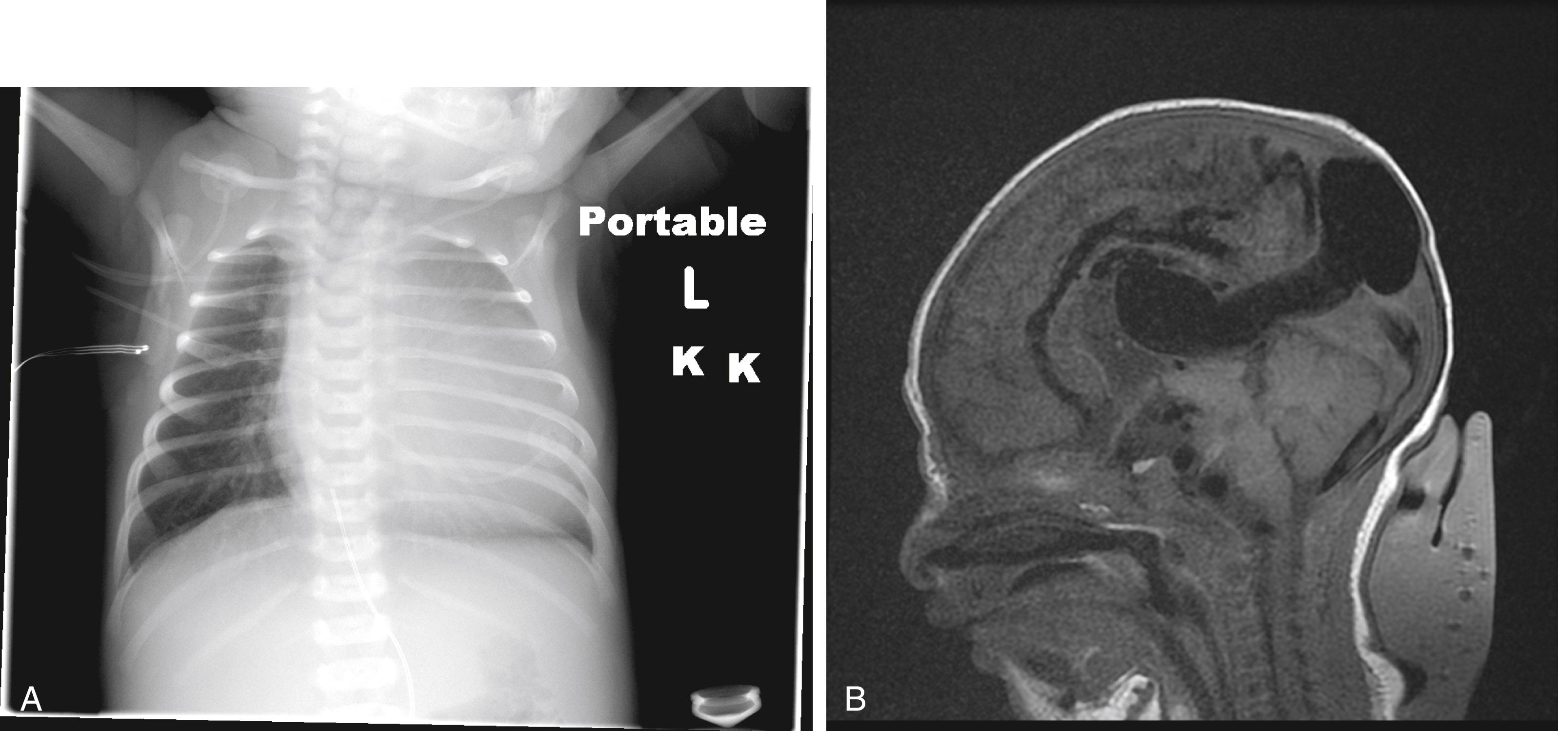 Fig. 2.1, Infant presented with desaturations. Chest x-ray with cardiac enlargement due to high-output cardiac failure (A) caused by shunt through large intracranial arteriovenous malformation (B) (in this case a vein of Galen malformation). A cranial bruit was heard over the anterior fontanelle and transmitted to the chest.