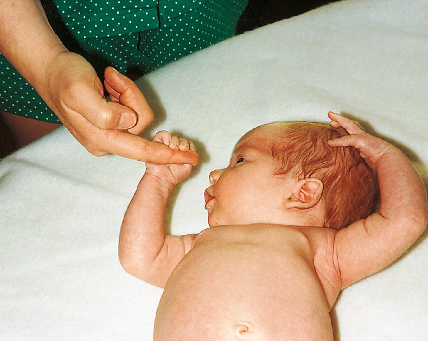 Fig. 2.14, Grasp reflex (palm). Transverse stimulation of the midpalm leads to a grasp by the infant.