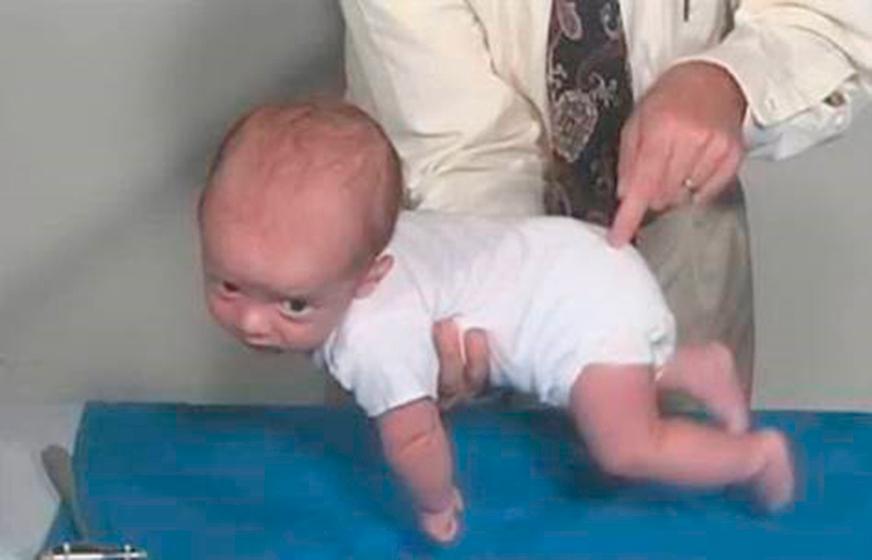 Fig. 2.16, Galant reflex. The position for assessing the Galant reflex is shown with infant held in ventral position. The examiner strokes cranial to caudal with their index finger along one side of the spine. The normal reaction is for the newborn to laterally flex toward the stimulated side.