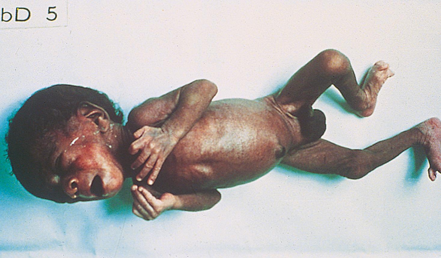 Fig. 2.18, Intrauterine growth retardation. This term baby weighed only 1.7 kg. The head appears disproportionately large for the thin, wasted body. This resulted from placental insufficiency late in pregnancy. Hypoglycemia may be a complication.