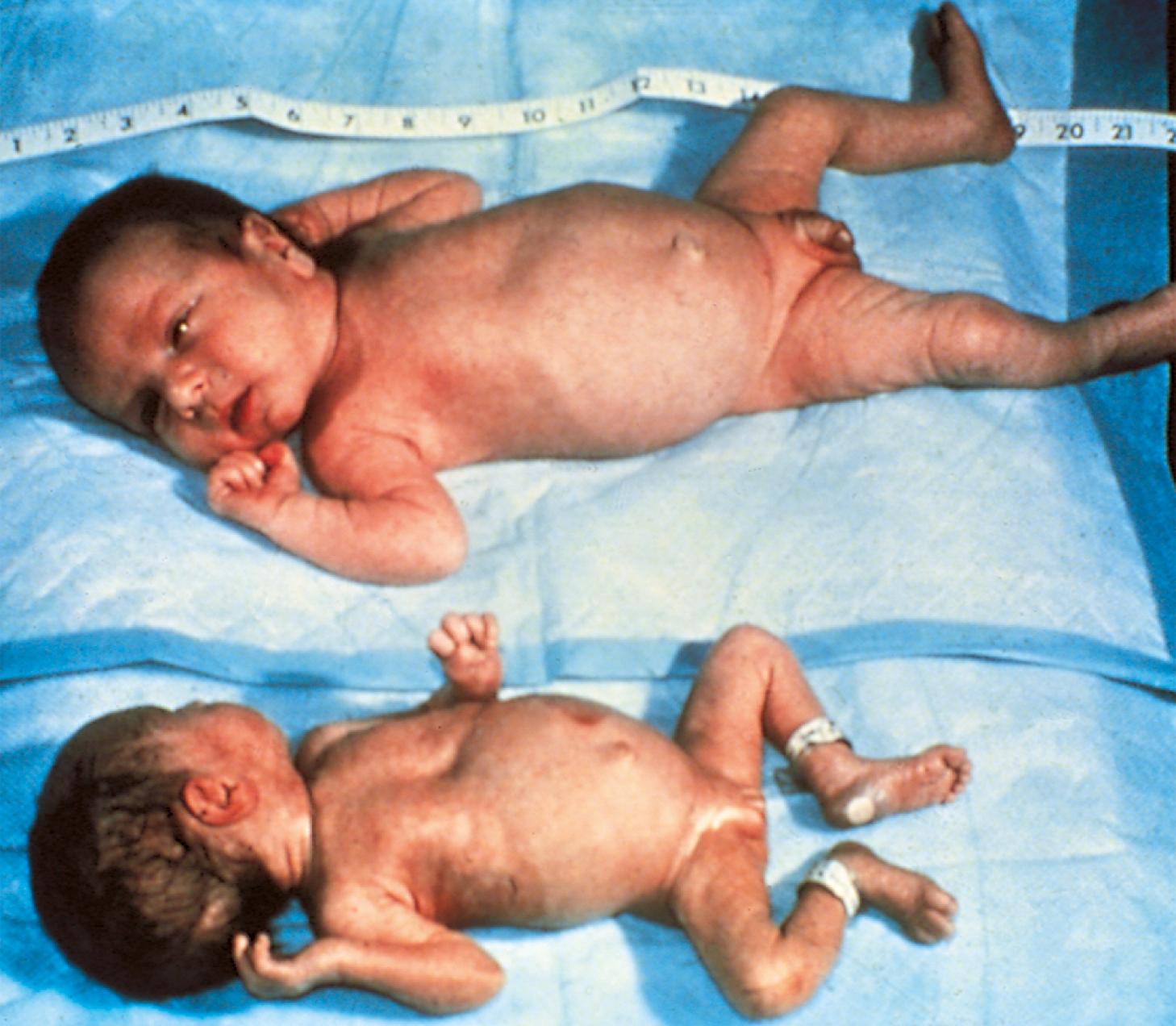 Fig. 2.19, Discordant twins. This is a pair of markedly discordant dizygotic twins. Disturbed placentation accounted for the marked reduction in size of the smaller twin.