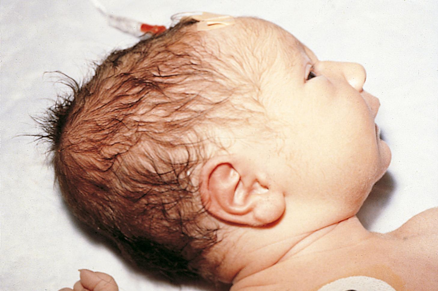 Fig. 2.21, Caput succedaneum. This infant has significant scalp edema as a result of compression during transit through the birth canal. The edema crosses suture lines.