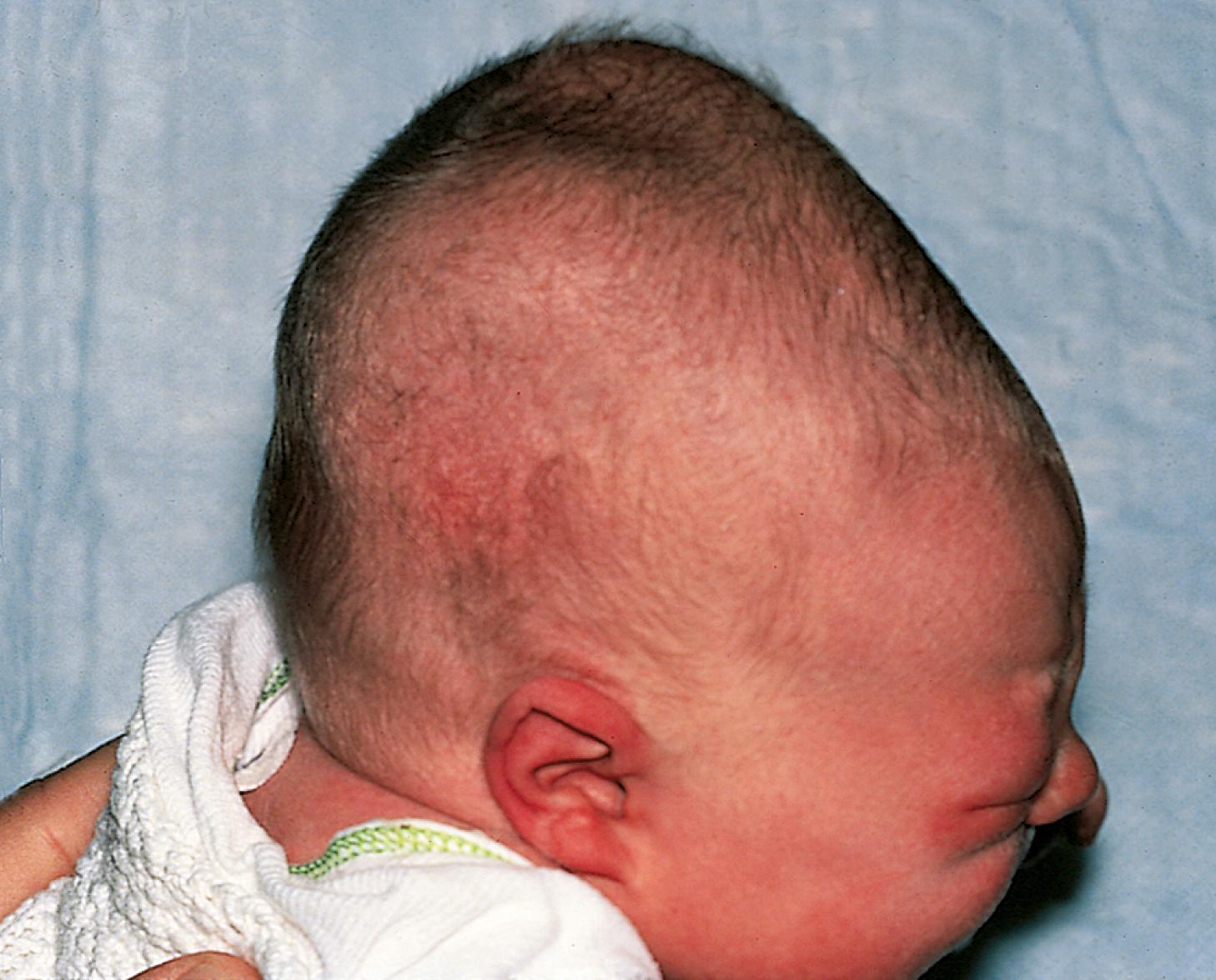 Fig. 2.23, Cephalohematoma. In this infant with bilateral cephalohematomas, the midline sagittal suture remained palpable, confirming the subperiosteal location of the hematomas.