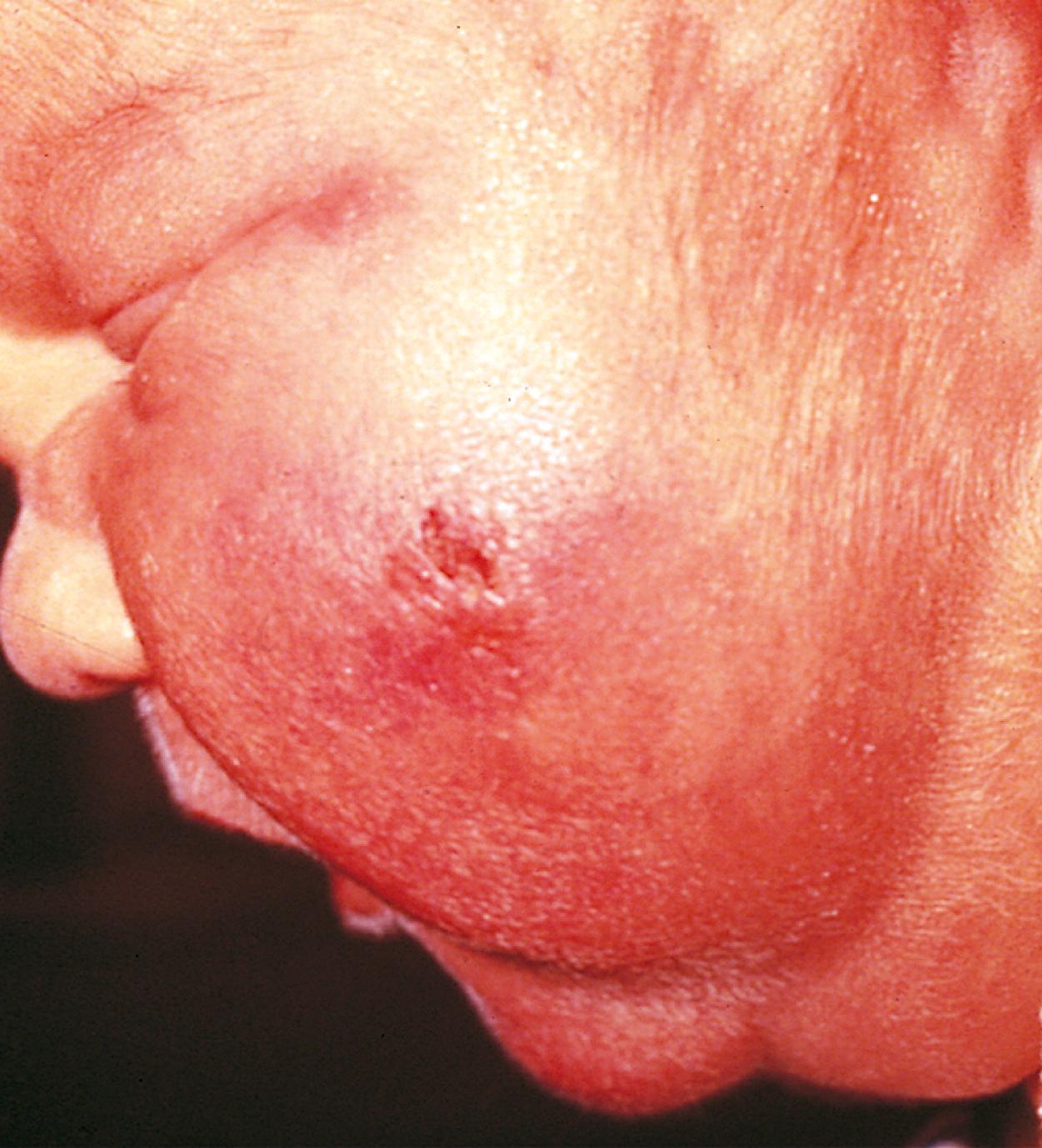 Fig. 2.25, Fat necrosis. This discolored nodular lesion on the cheek is characteristic of subcutaneous necrosis of fat secondary to forceps trauma.