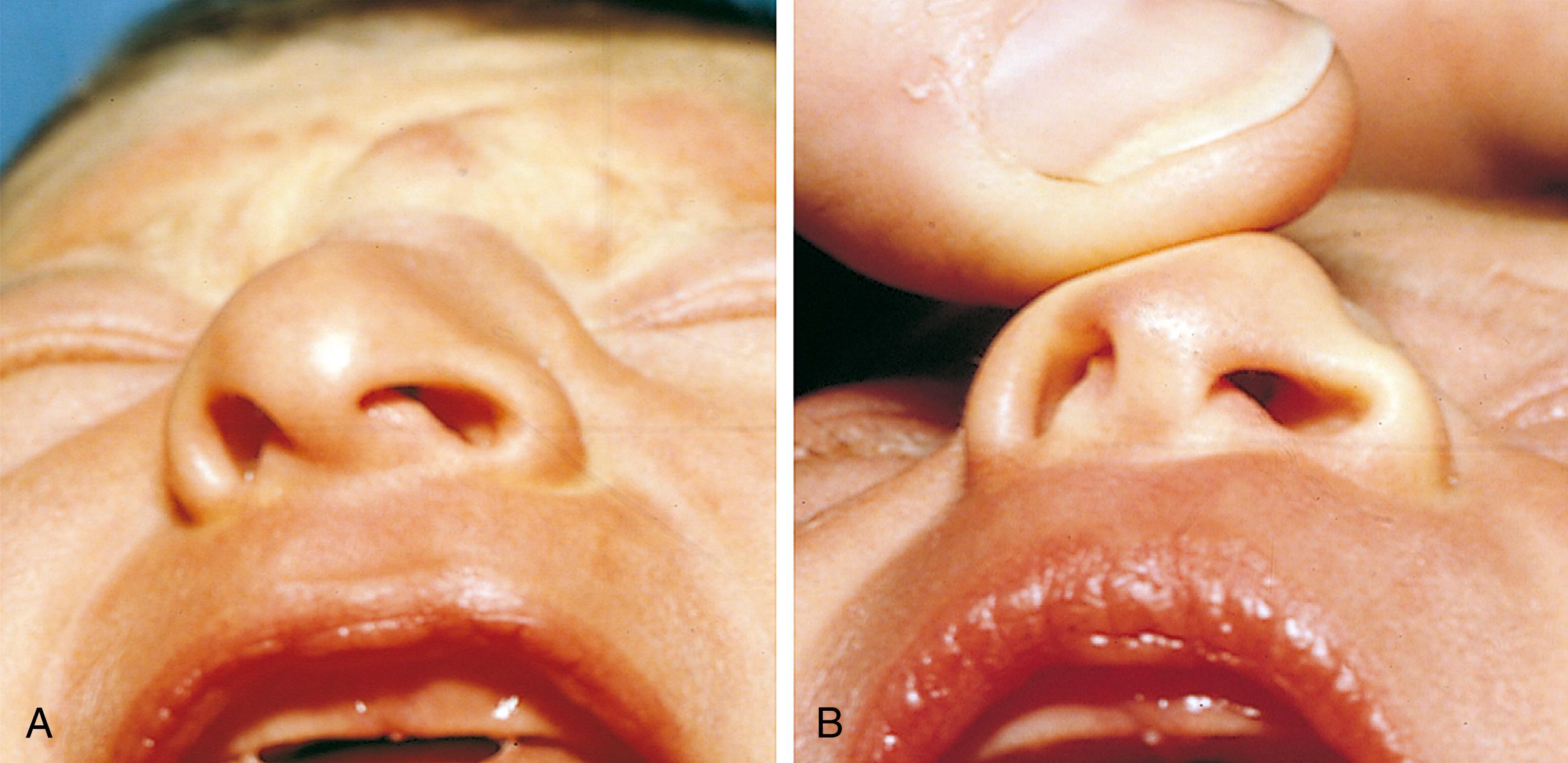 Fig. 2.26, Nasal deformity. This infant incurred dislocation of the triangular cartilage of the nasal septum during delivery. (A) Inspection of the nose reveals deviation of the septum to the right and asymmetry of the nares. (B) When the septum is manually moved toward the midline, the asymmetry persists, confirming the dislocation.