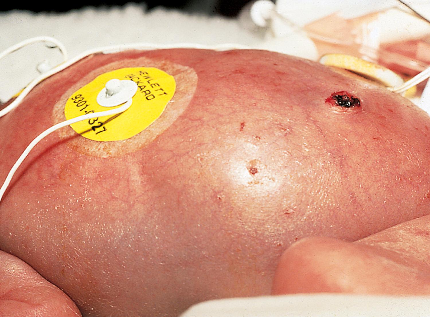 Fig. 2.3, Premature skin. This premature infant demonstrates translucent, paper-thin skin with a prominent venous pattern.