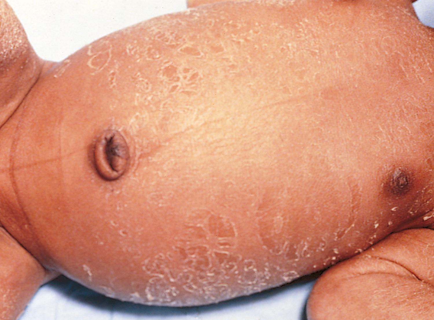 Fig. 2.4, Post-term skin. Peeling and cracking of the skin are characteristics of the infant delivered after 42 weeks’ gestation.