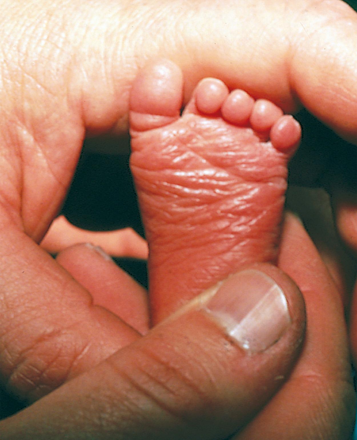 Fig. 2.6, Sole creases. Transverse sole creases cover approximately half the sole in this infant, indicating a gestational age of approximately 34 weeks.