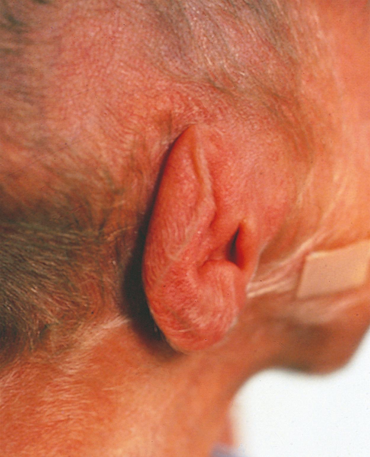 Fig. 2.7, Ear cartilage. The lack of cartilage and the easy foldability (lack of recoil) are evident in the ear of this premature infant at 26 weeks.