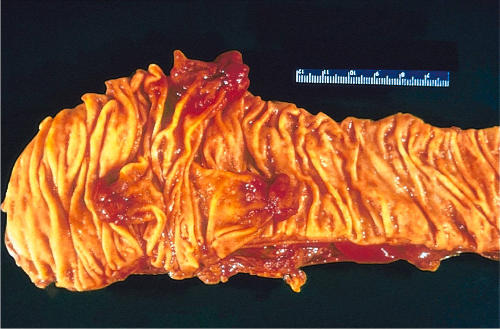 FIG. 6.1, Colonic polyps. Several pedunculated “velvety” polyps are seen in this segment of colon.