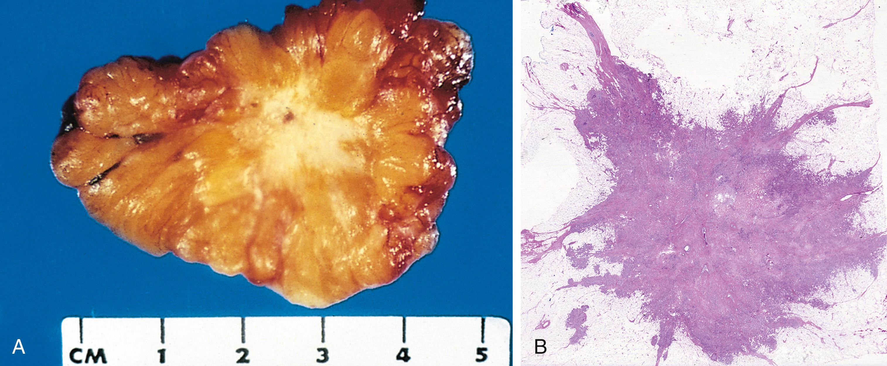 FIG. 6.8, Invasive ductal carcinoma of the breast. (A) Cut section shows that the stony-hard lesion is retracted and infiltrates the surrounding breast substance. (B) A microscopic view shows invasion of breast stroma and fat by nests and cords of tumor cells. Note the absence of a well-defined capsule.