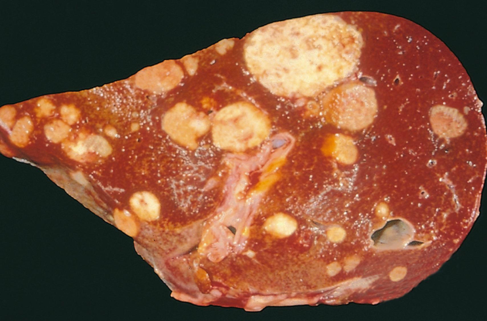 FIG. 6.9, A liver studded with metastatic cancer.