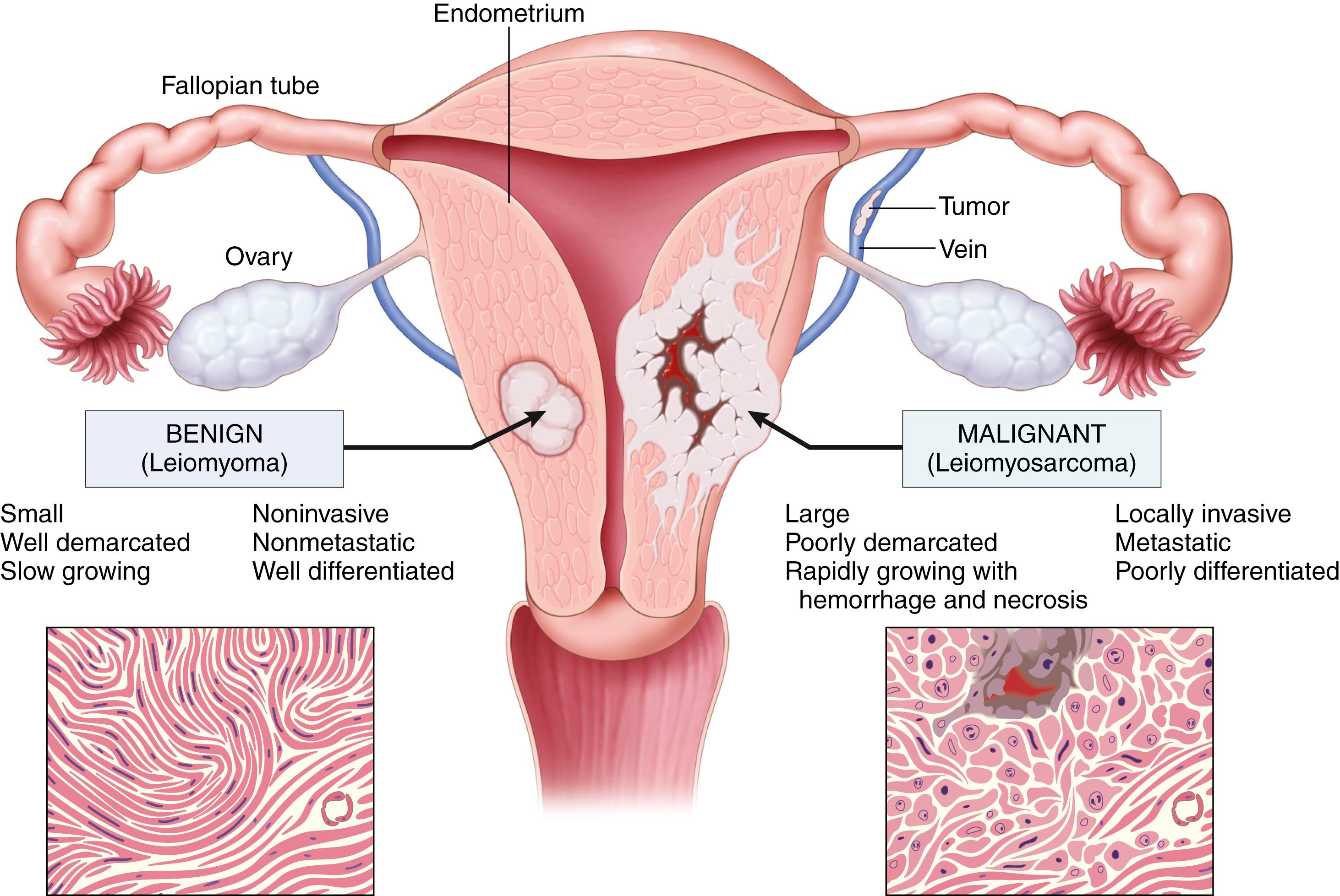 FIG. 6.10, Comparison between a benign tumor of the myometrium (leiomyoma) and a malignant tumor of similar origin (leiomyosarcoma).