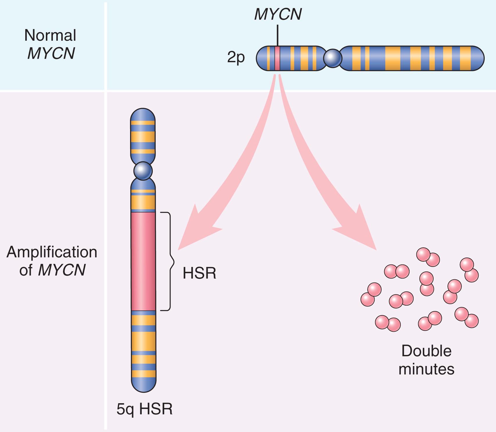 FIG. 6.13, Amplification of the MYCN gene in human neuroblastoma. The MYCN gene, present normally on chromosome 2p, becomes amplified and is seen either as extrachromosomal double minutes or as a chromosomally integrated homogeneous-staining region (HSR).