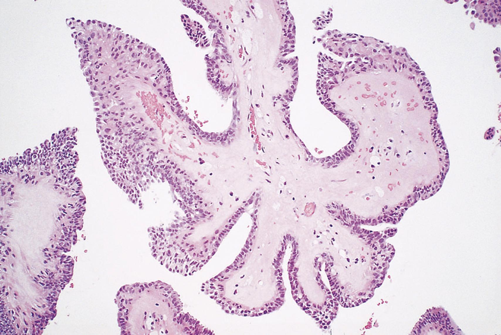 eFIG. 6.1, Intraductal papilloma of breast. The papillary fronds have a fibrovascular core and are lined by epithelium.