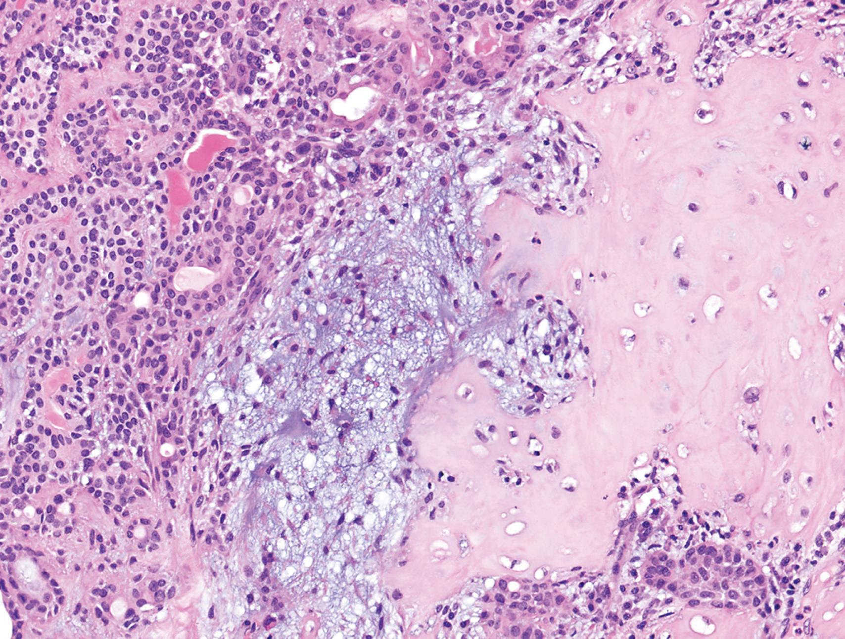 FIG. 6.2, Mixed tumor of the parotid gland. Areas containing nests of epithelial cells (on the left) and myxoid stroma forming cartilage and bone (an unusual feature, on the right) are present in this field.