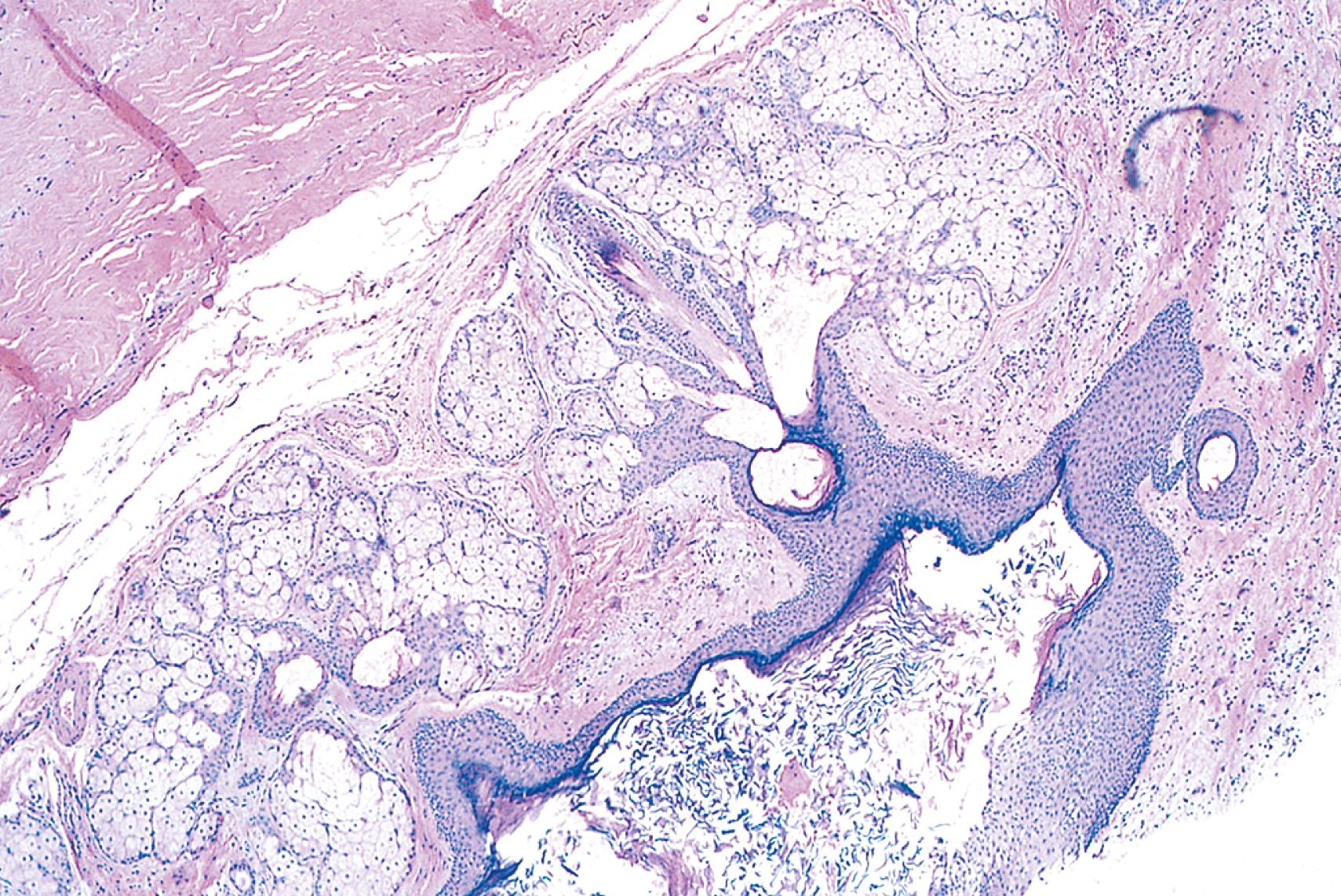 eFIG. 6.2, Benign cystic teratoma (dermoid cyst) of the ovary. A cystic space is lined by benign squamous epithelium underlaid by soft tissue containing hair follicles and sebaceous glands.